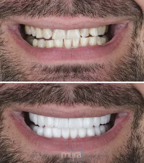 Teeth Turkey Pictures for a reconstruction case by 28 Zirconium Crowns and get a perfect result and happy smile.
