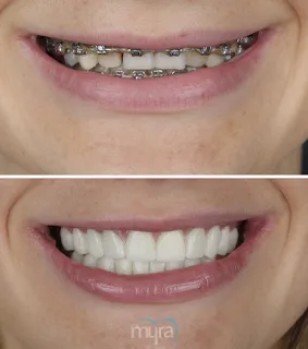 Teeth Turkey Pictures for a smile makeover case. She got braces first and then 24 Zirconium Crowns done.