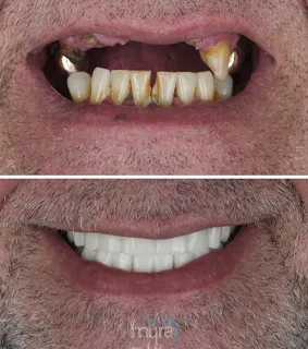 Teeth Turkey Pictures before after for teeth implants on front teeth. He get 28 crowns and a reconstruction with teeth implants.
