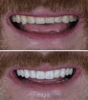Teeth Turkey Pictures with 20 Zirconium Crowns and 3 dental implants for missing teeth.