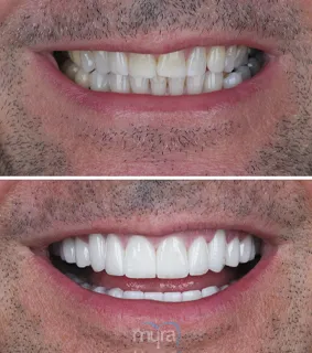 Teeth Turkey Pictures for a cross bite case. We done 26 Zirconium Crowns and changed all the smile.