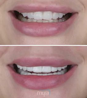 Teeth Turkey Pictures for a narrow smile case with 24 Emax Laminate Veneers and get widened smile