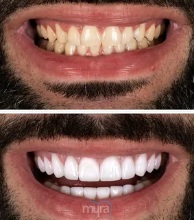 Teeth Turkey Pictures for laminate veneers with emax. He tried to correct misaligned smile with aligners and get full set of veneers.