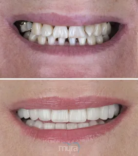 Teeth Turkey Pictures before and after for a gapsy smile. In this case 26 Zirconium Crowns and 6 teeth Implants has done.