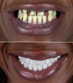 Teeth Turkey Pictures for missing teeth and cross bite on front side. We corrected case with a reconstruction treatment with crowns and implants