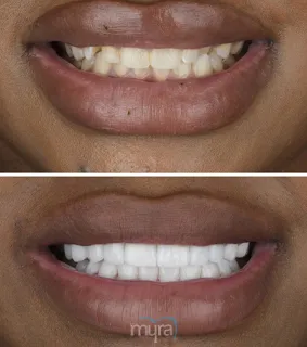Teeth Turkey Pictures has done for a crossbite teeth case with 20 Zirconium Crowns as BL0 colour.