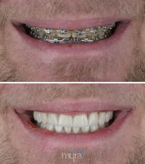 Teeth Turkey Pictures for a misliagned teeth with 18 Emax Laminate Veneers and 9 Zirconium crowns.