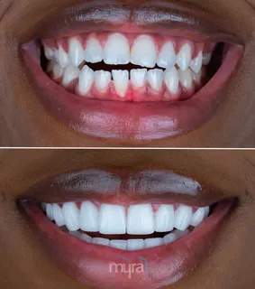 Teeth Turkey Pictures for 20 Zirconium Veneers for an open smile case correction.