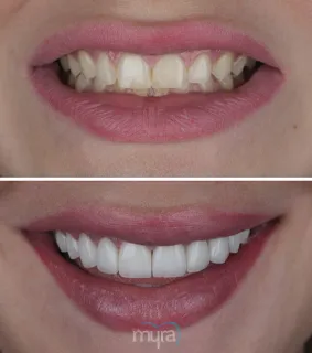 Teeth Turkey Pictures for a deep bite and narrow smile case. We rised bite by overlays and 20 Emax Laminate Veneers which are BL2 colour.