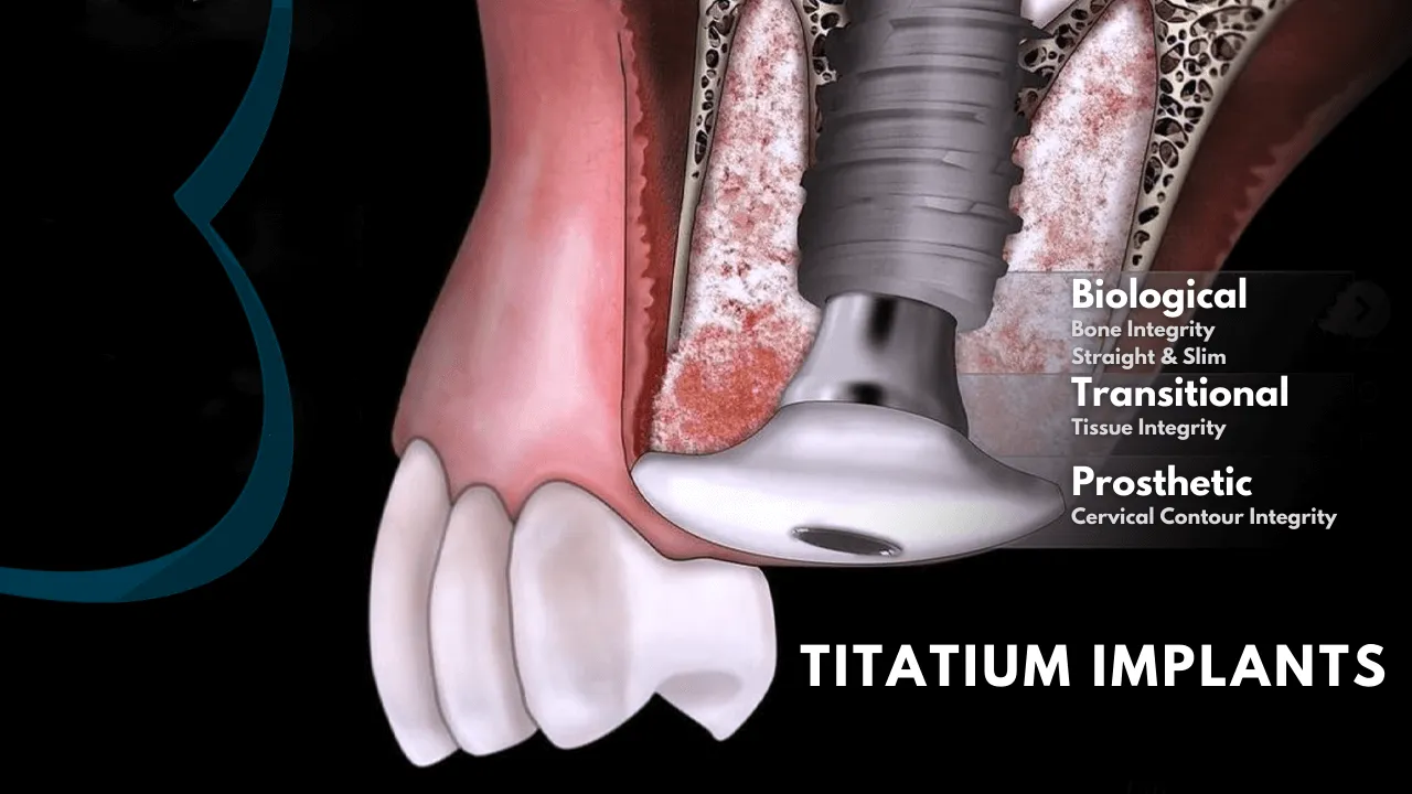 Why.is.Titanium.an.Ideal.Material.for.Dental.Implants.in.turkey.png 