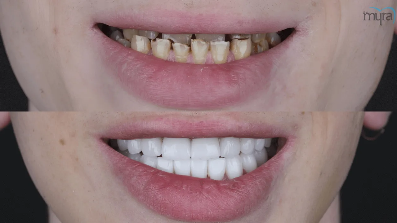 What-are-the-Differences between Cracked-Tooth-and-Crooked-Teeth 