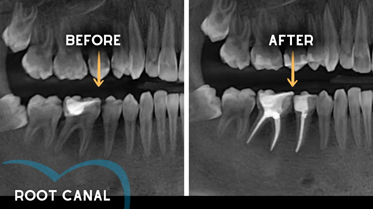 What does an Endodontist do (1) 