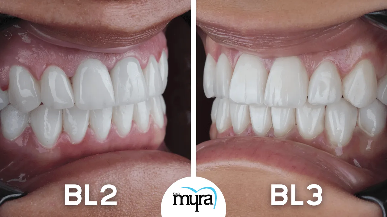 What-does-BL2-and-BL3-Veneers-look-like-before-and-after-in-Turkey 