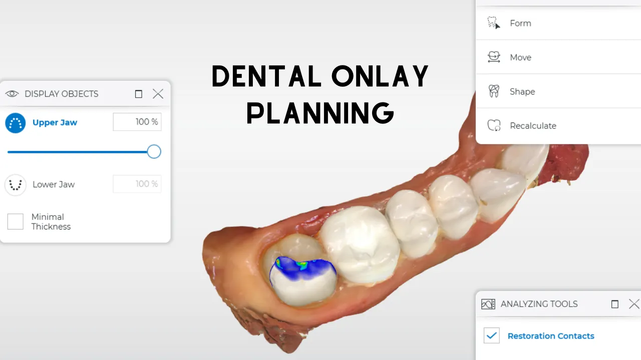 2.Dental.Onlay.in.turkey 