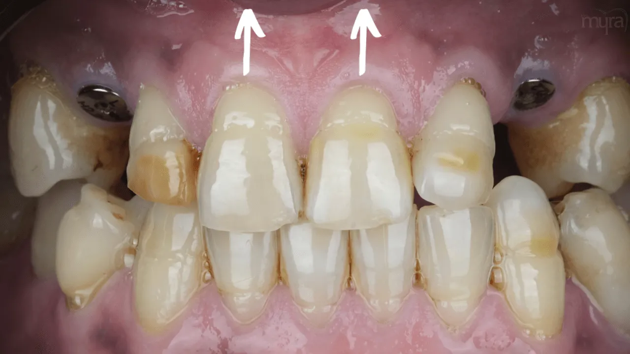 receding-gums 