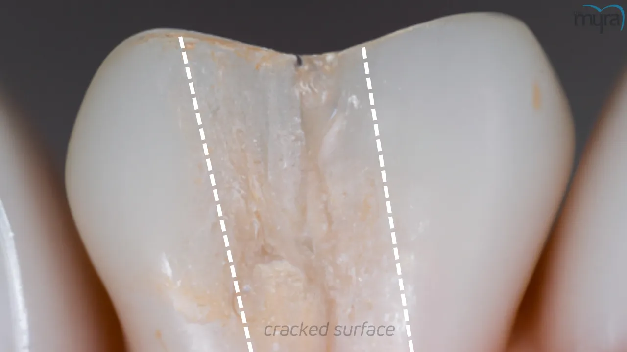 What-are-the-Causes-Cracked-Tooth 