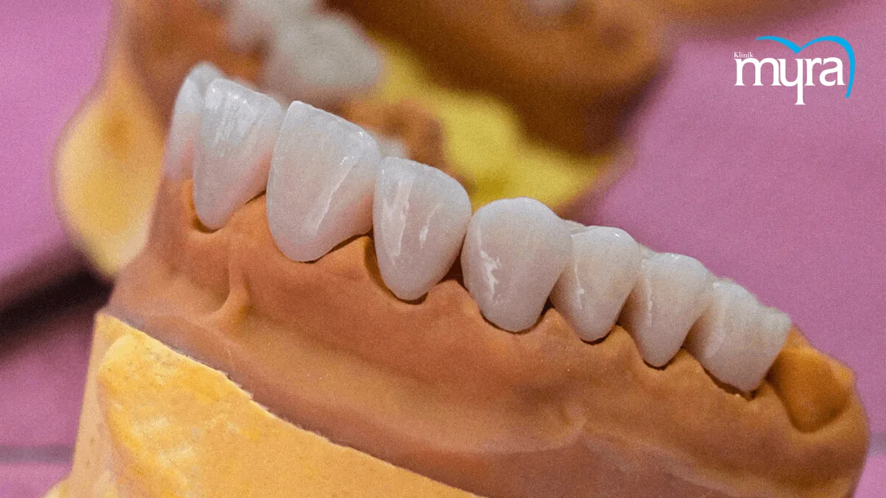 What-are-Dental-Veneers-in-Turkey 