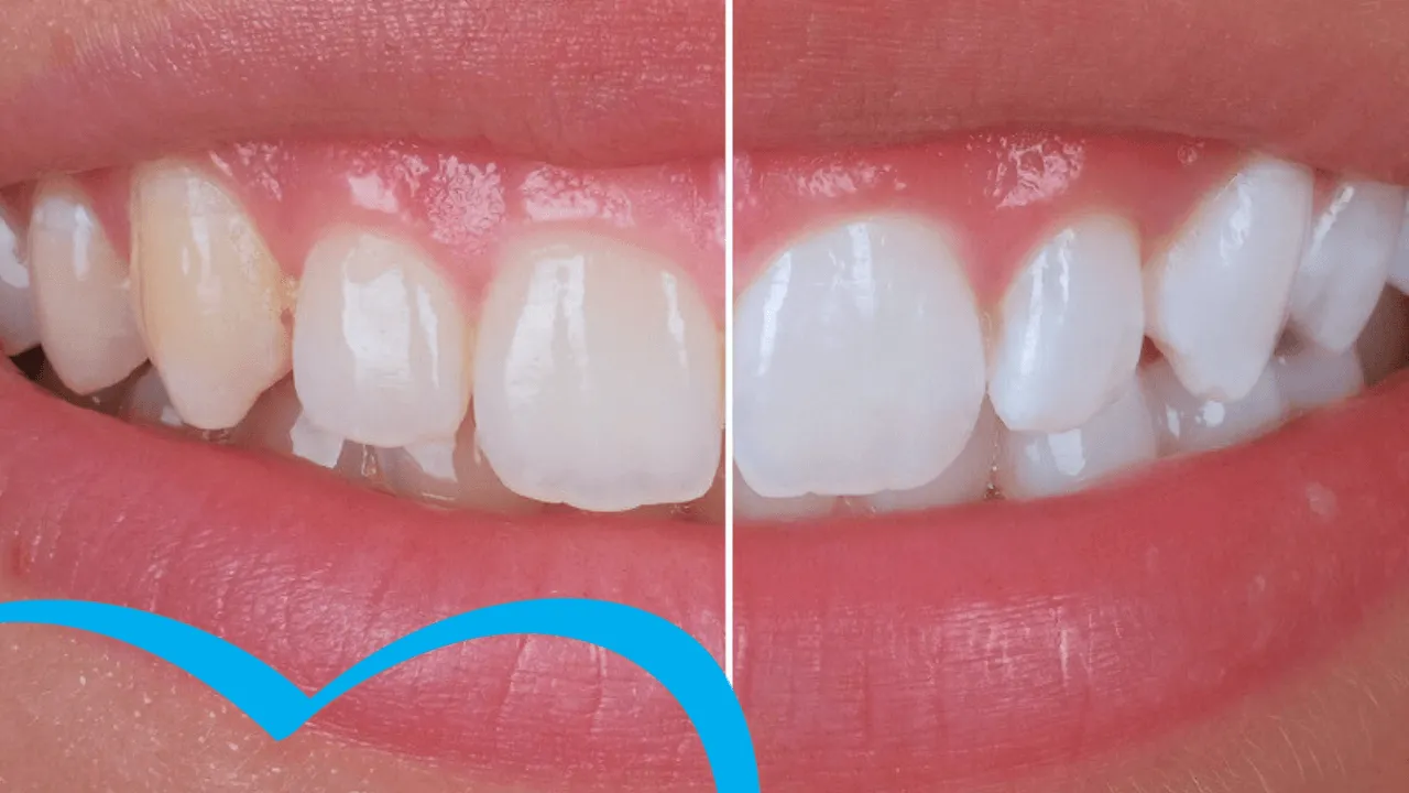 4.teeth.Whitening.in.turkey 