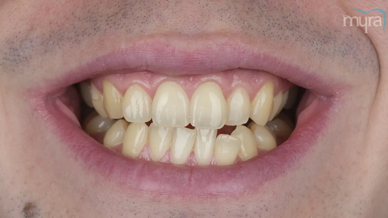 What-are-the-Symptoms-of-Crooked-Teeth 