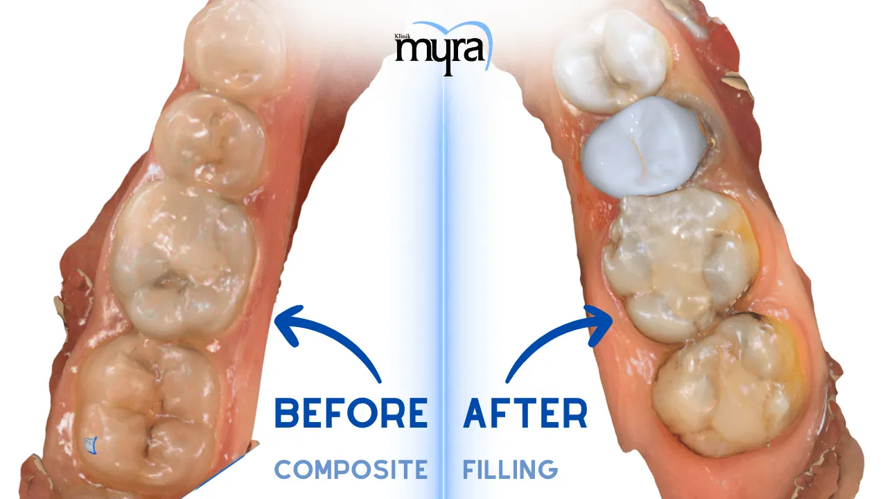 How.does.a.Denta. Filling.look.Before.and.After.in.turkey 