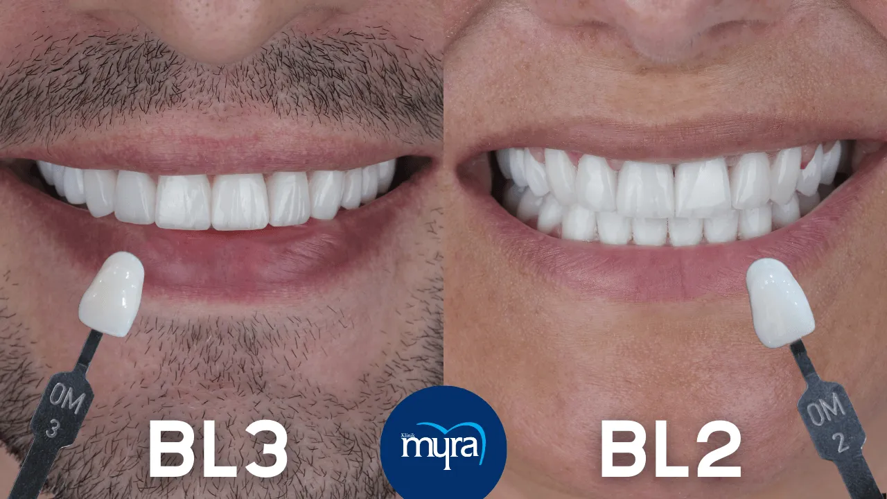 BL2 vs BL3 Veneers