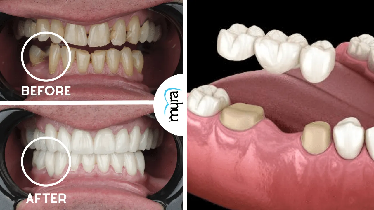 Dental Bridge vs Implant: Key Differences and Factors in Choosing