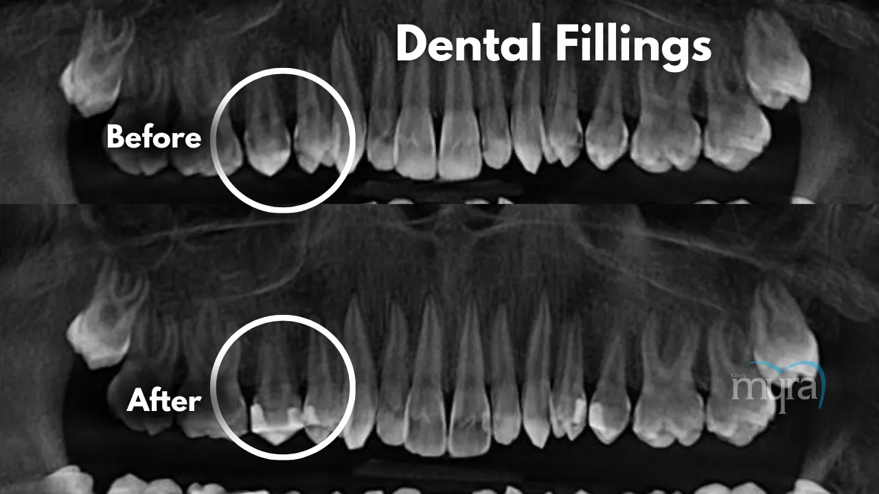 When.are.Dental.Fillings.needed.in.turkey 