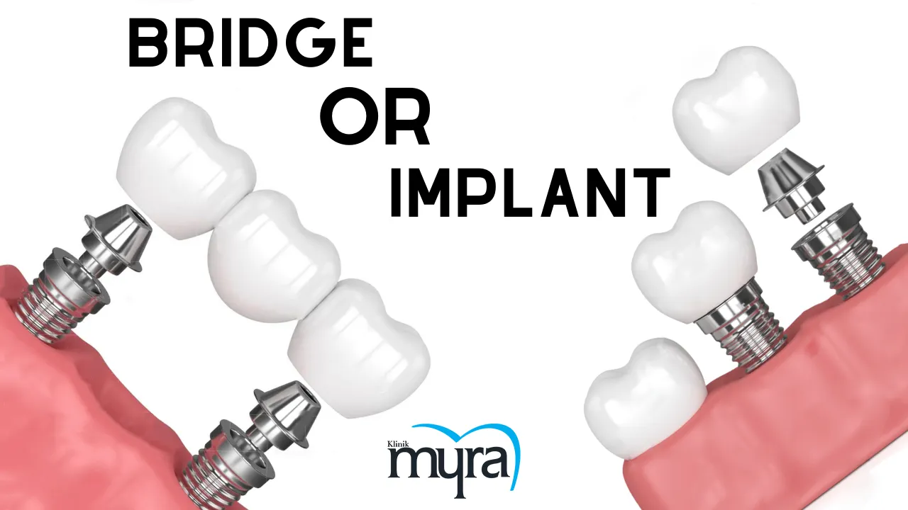 What.are.the.Factors.in.Choosing.between.Dental.Bridges.and.Implants.in.turkey copy 