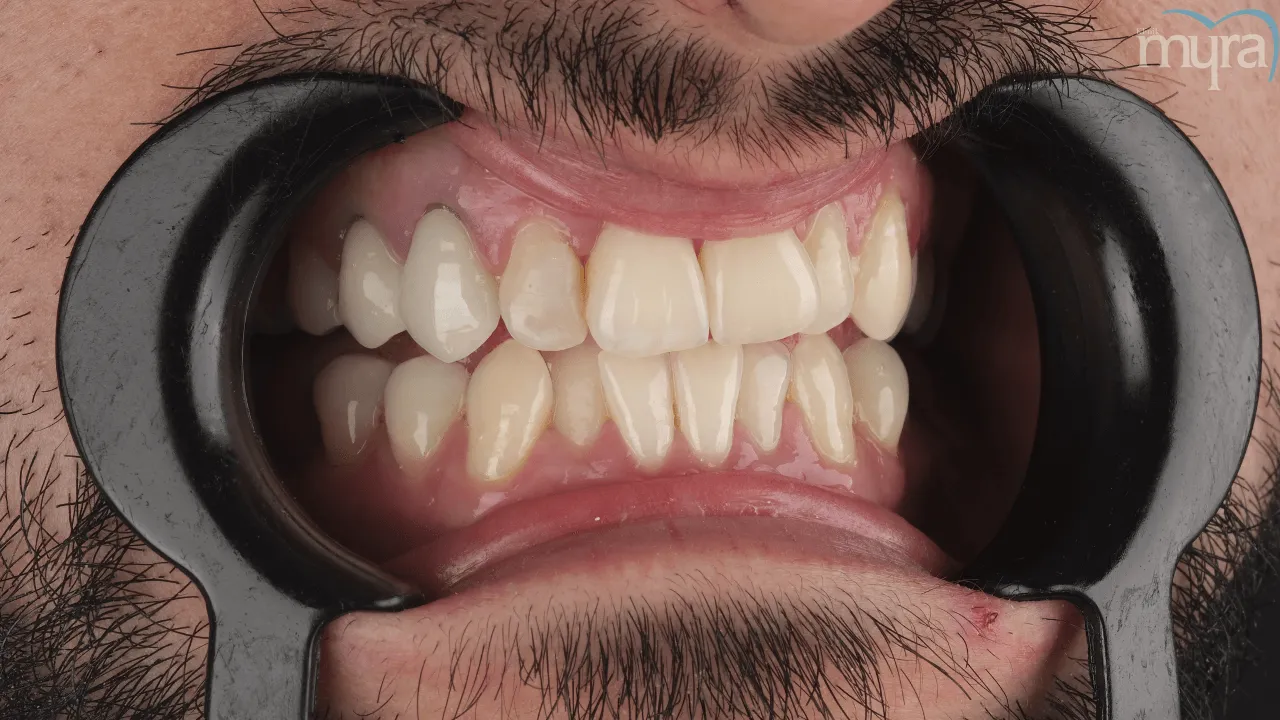 Crooked-Teeth-Symptoms-Treatment-Causes 