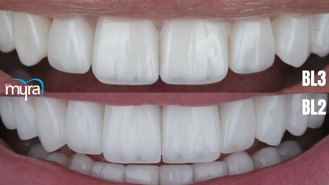 What are the Key Differences between BL2 and BL3 Veneers 