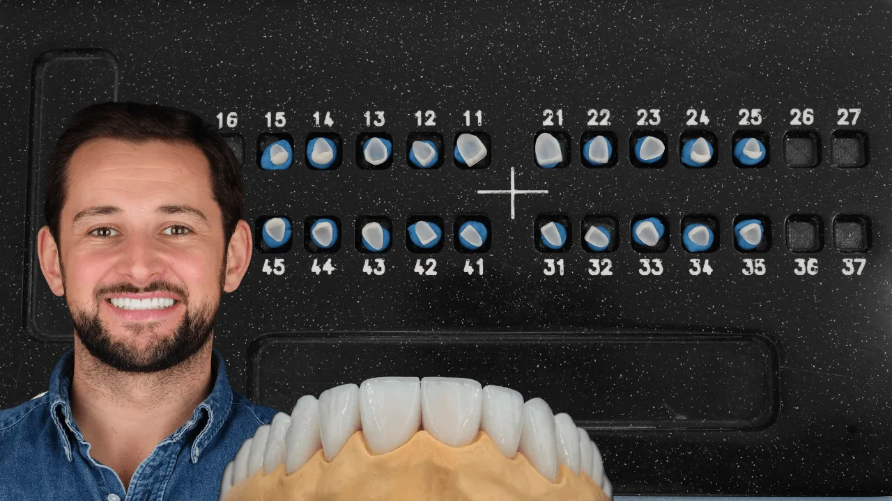 7.Dental.Veneers.in.turkey 