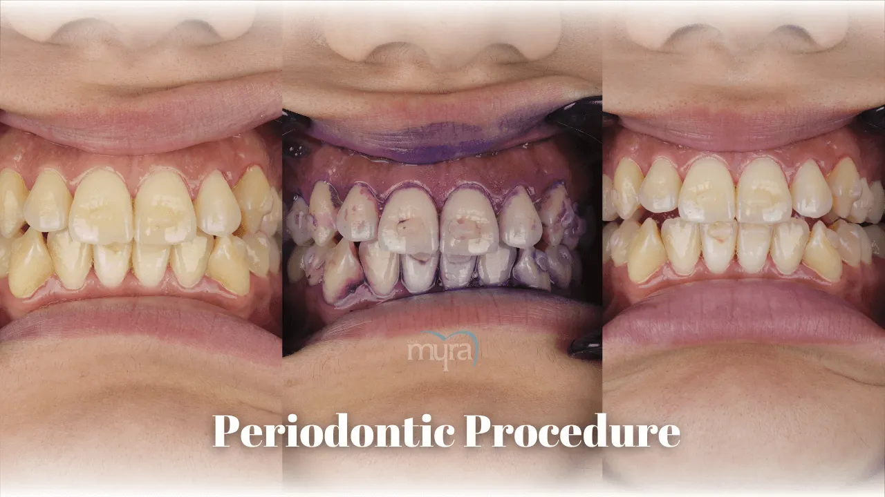 What.to.Expect.after.a.Periodontic.Procedure.in.turkey 