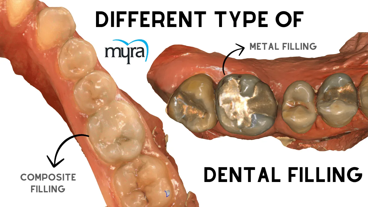 What.are.the.types.of.Filling.Materials.for.Dental.Fillings.in.turkey 