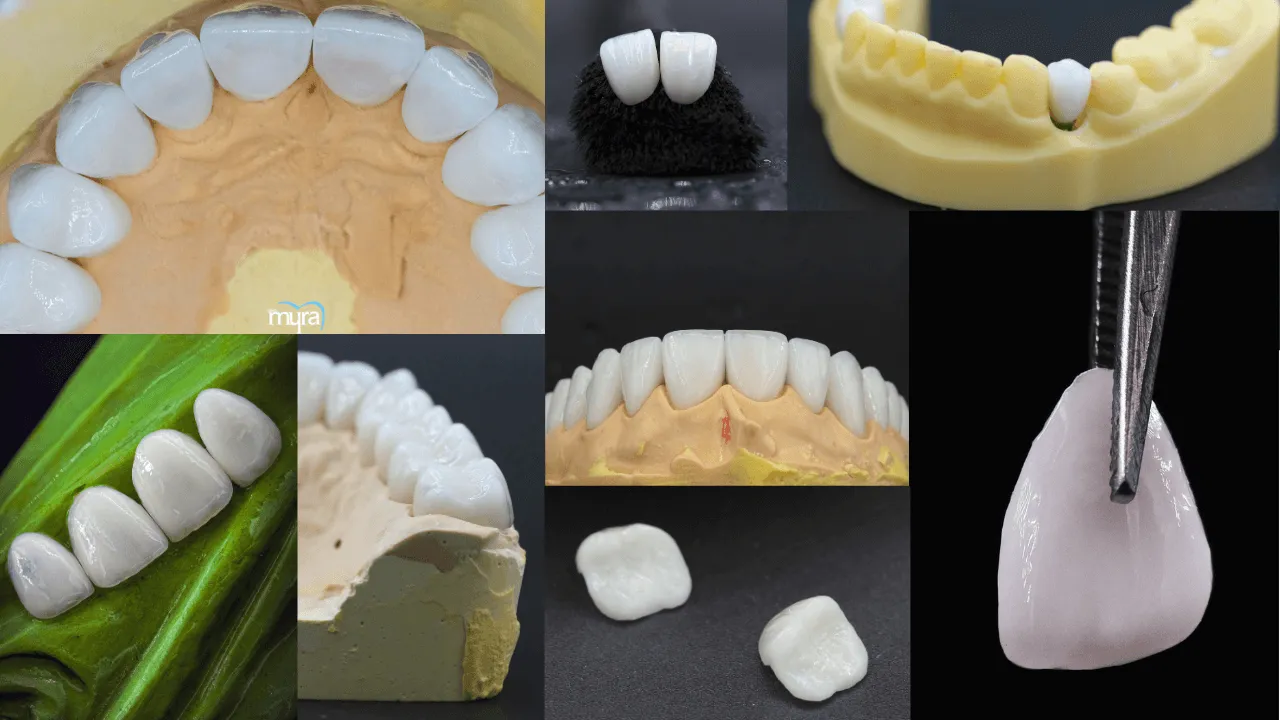 What.Dental.Treatments.are.done.by.Prosthodontists.in.turkey 