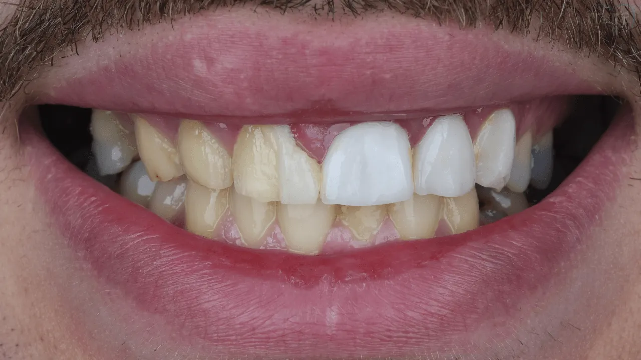 Teeth Discoloration 