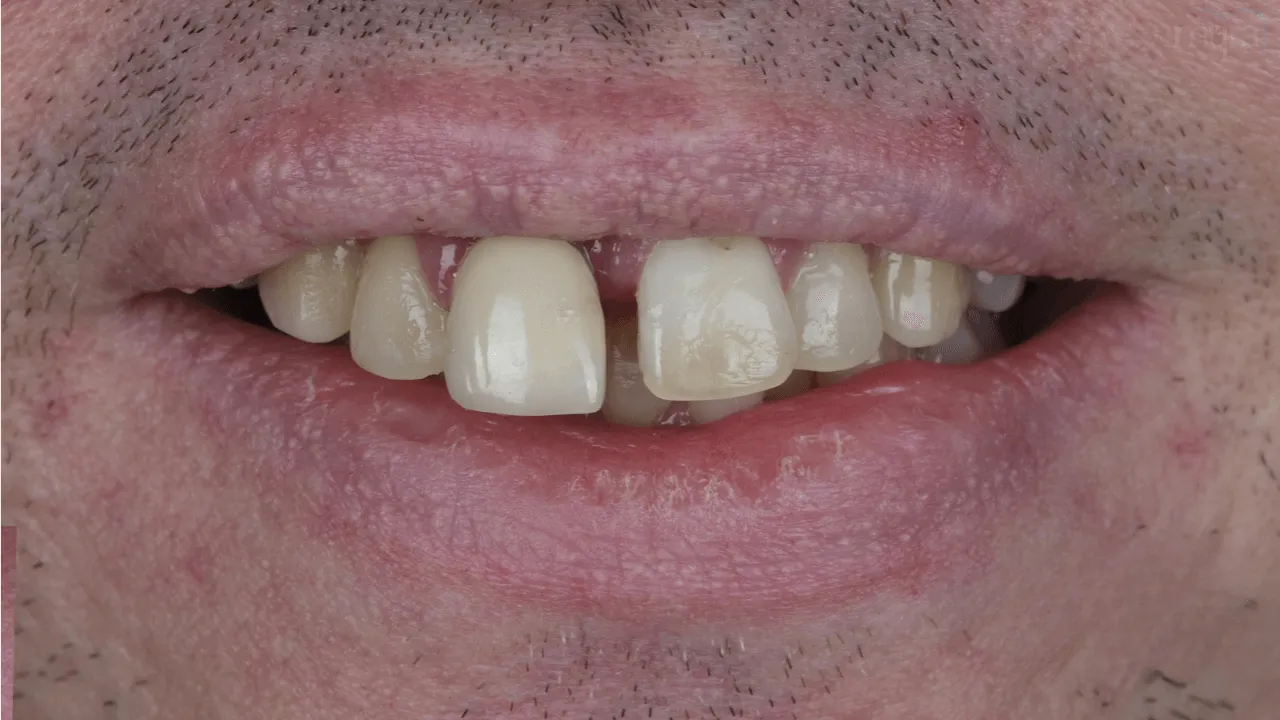 gap-between-teeth 