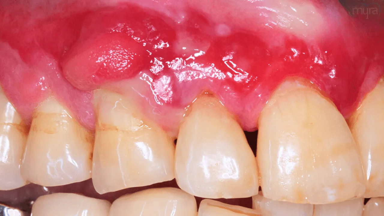 gum-disease 