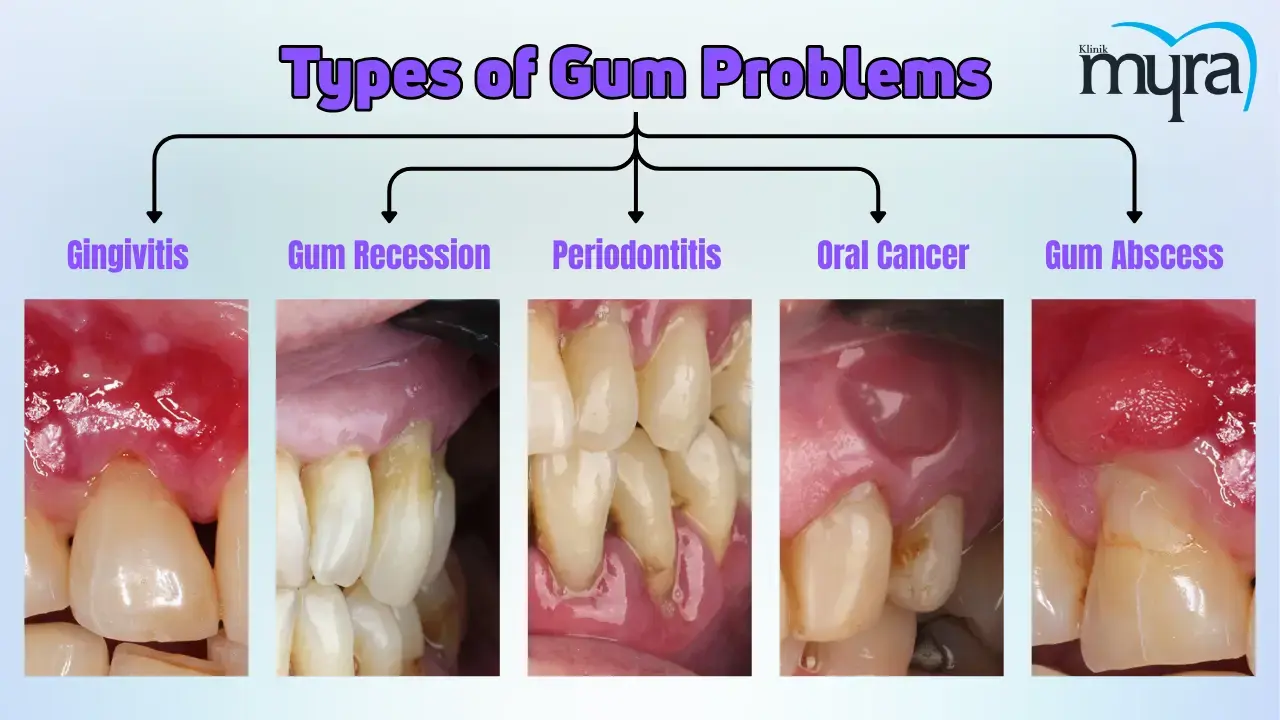 Gum Problems: Symptoms, Treatment, Causes