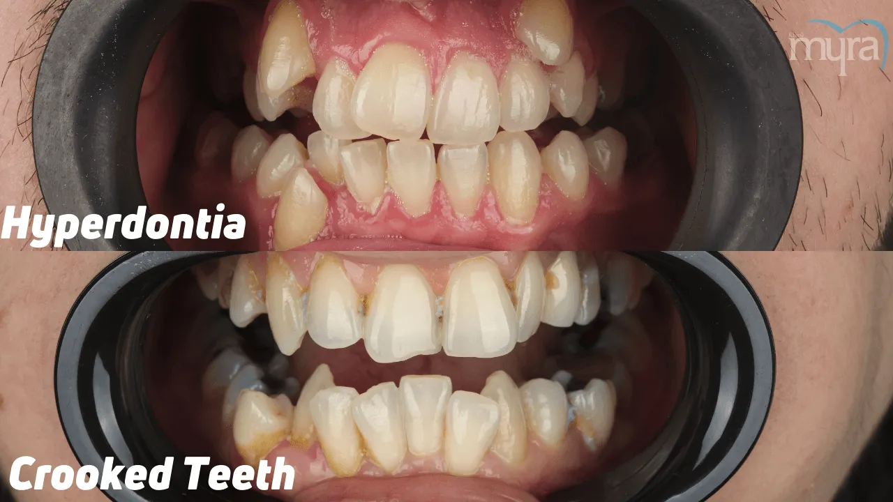 What-are-the-Differences-between-Crooked-Teeth-and-Hyperdontia 