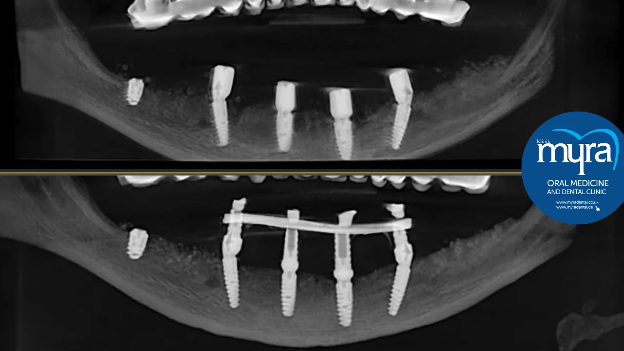 What.are.the.Risks.associated.with.Titanium.implants.in.turkey 