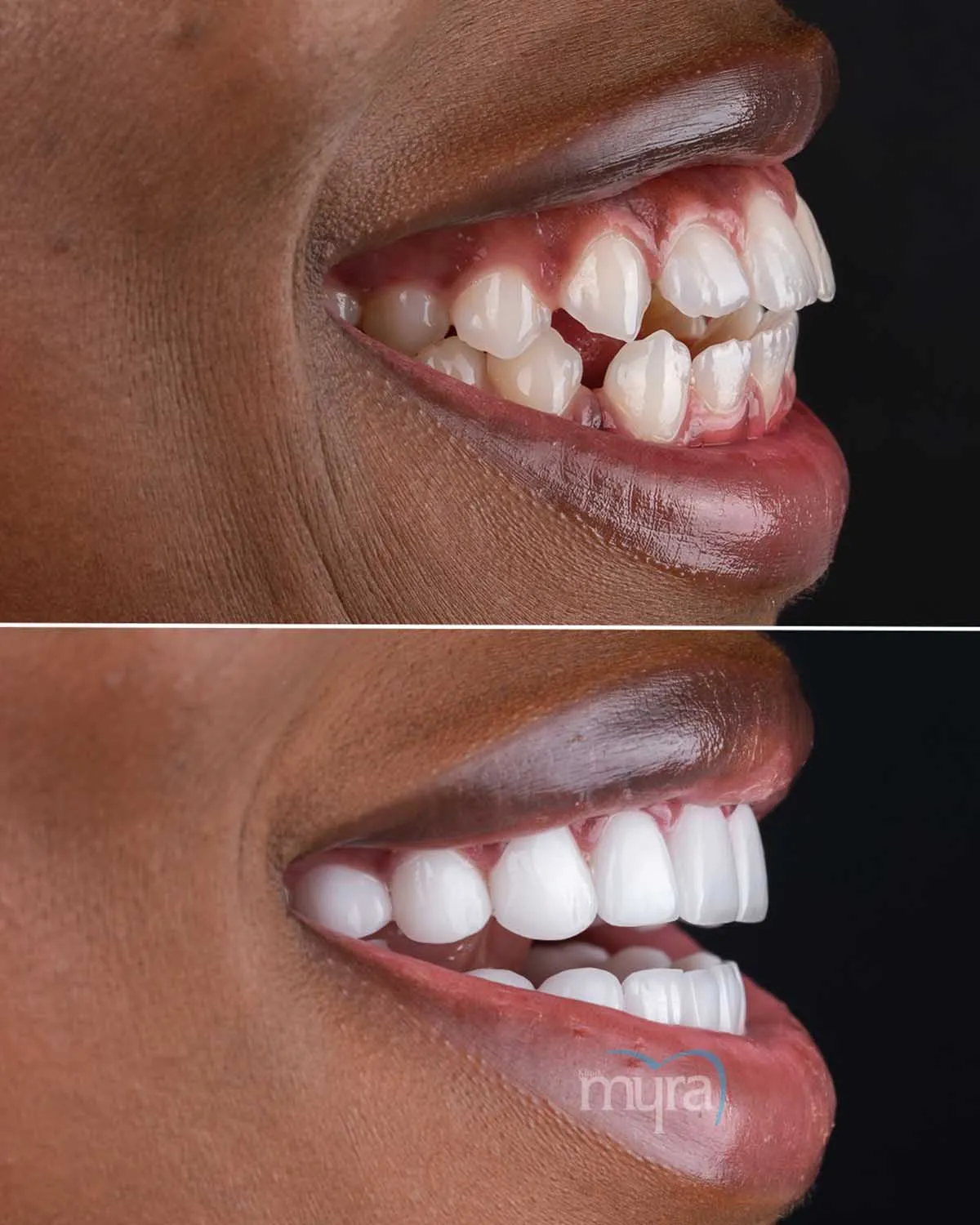 teeth veneers