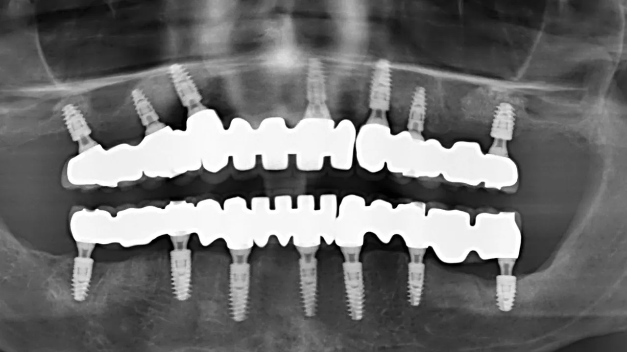 Best Way to Clean Dental Implant