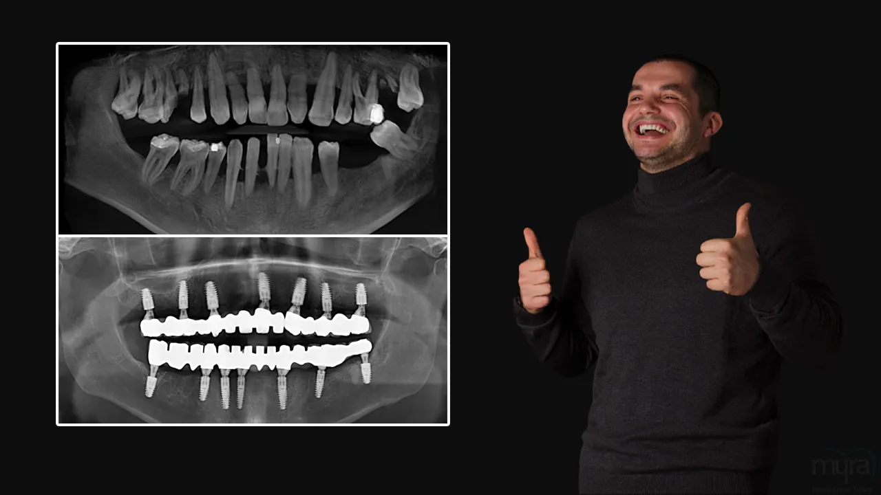 Dental Bridge Definition, Types, Cost, and Recovery Duration