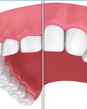 Laser Gum Contouring  Benefits and Risks, Procedure, Cost